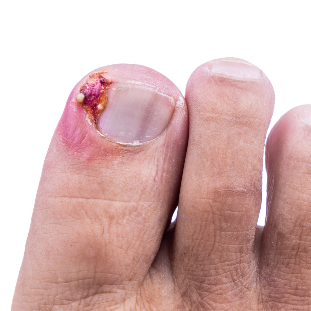 voet ingegroeide nagel