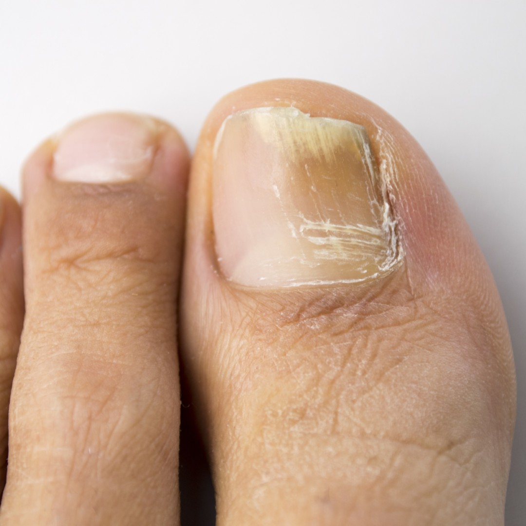 voet kalknagel